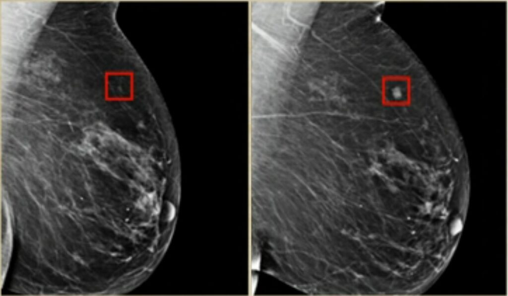 Links het als risico bestempelde deel van de borst. Rechts een foto van dezelfde borst, maar dan vier jaar later. borstkanker